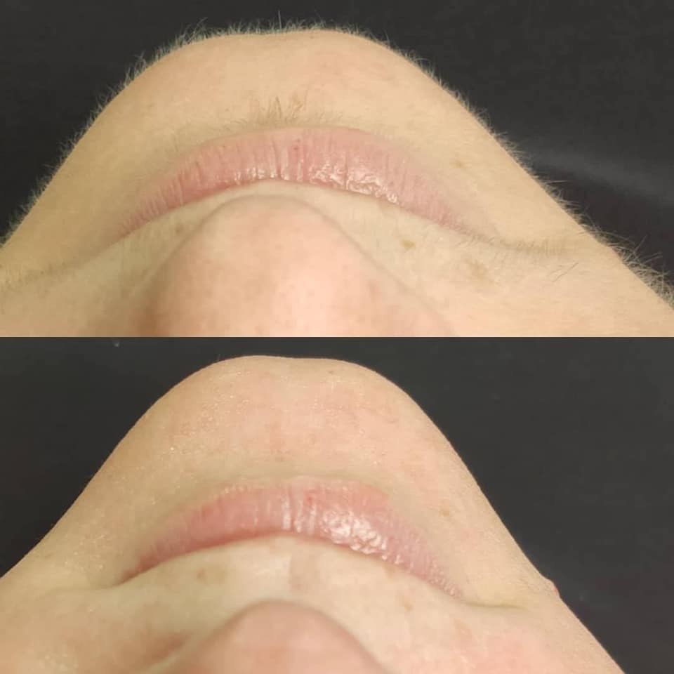Derma