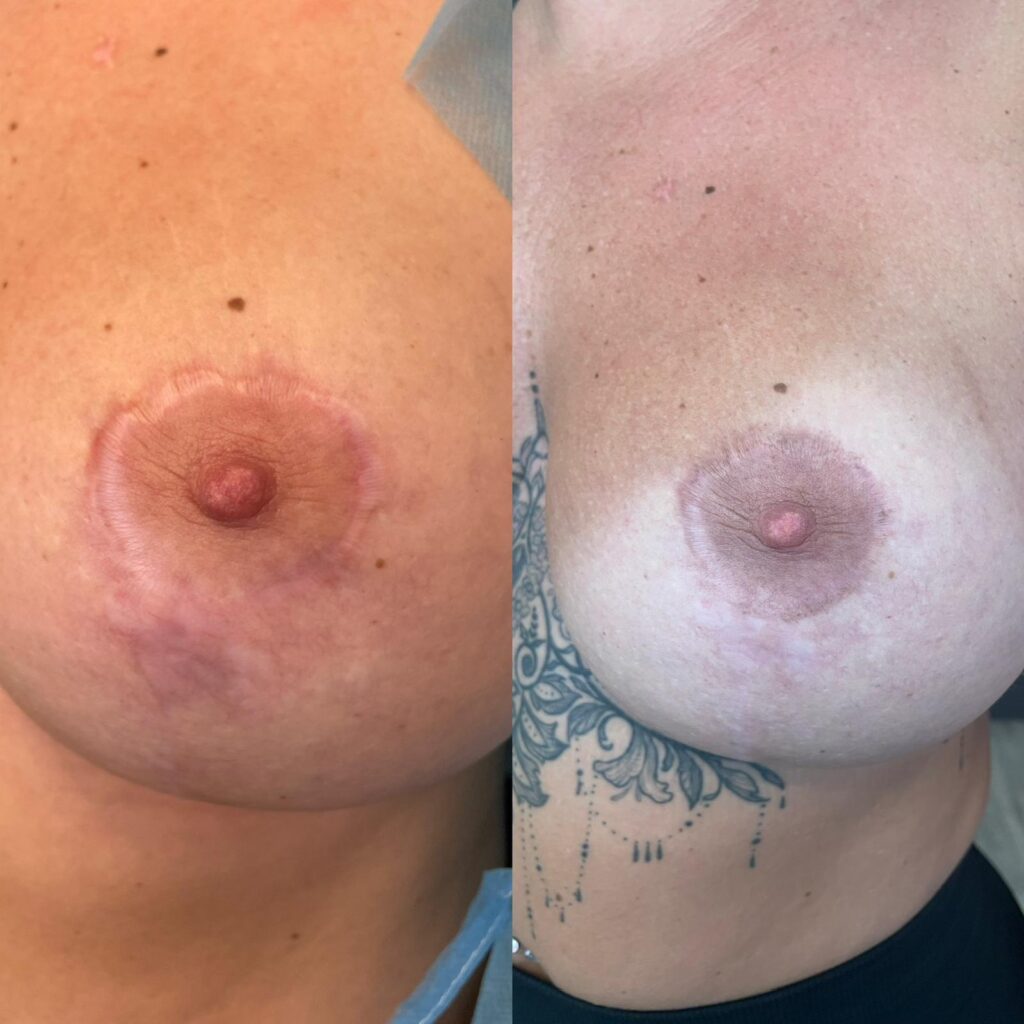 MCA Areola