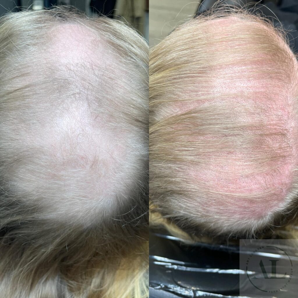 Scalp Density