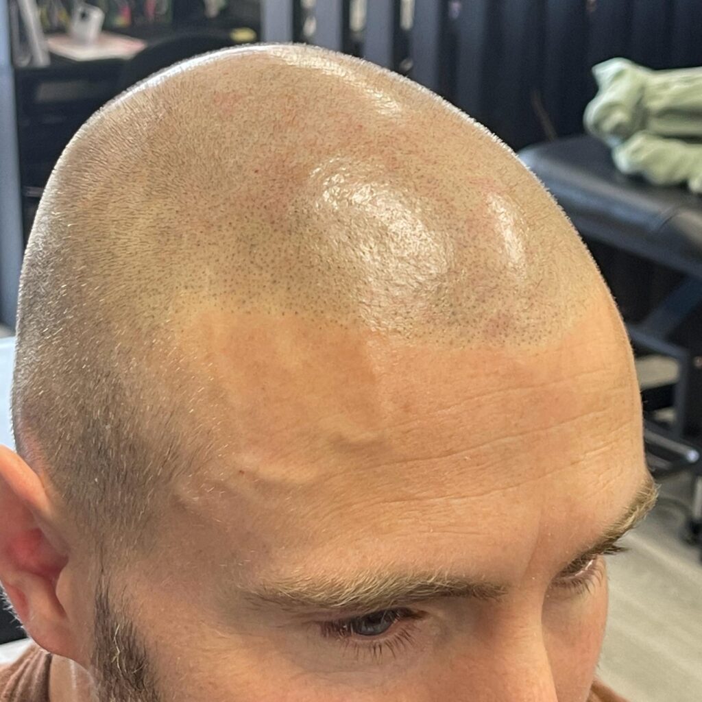 Scalp Shaved